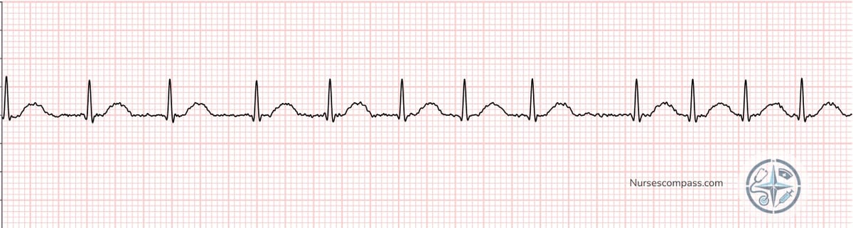 Atrial Fibrillation EKG Strip