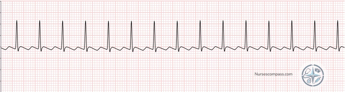 Atrial Flutter EKG Strip