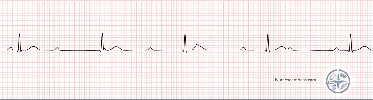 Complete Heart Block (3rd Degree) EKG Strip