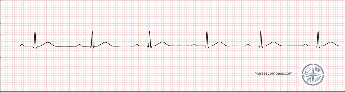 First-Degree AV Block EKG Strip