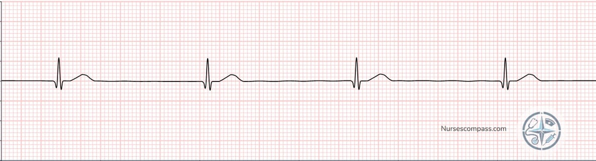 Junctional Rhythm EKG Strip