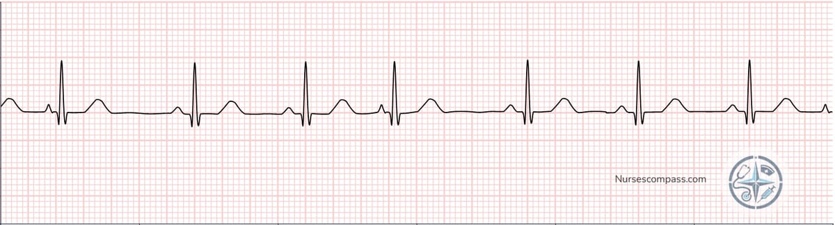 Premature Atrial Contractions (PACs) EKG Strip