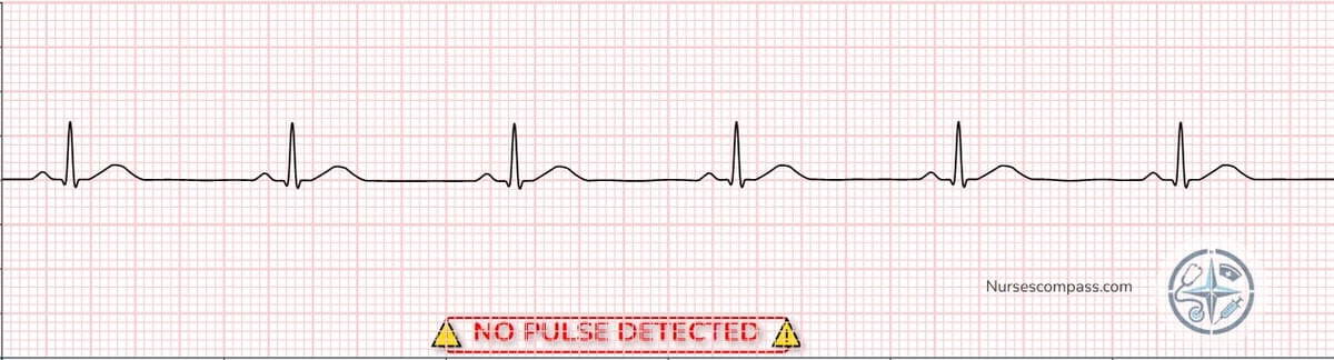 Pulseless Electrical Activity (PEA) EKG Strip