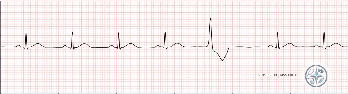Premature Ventricular Contractions (PVCs) EKG Strip