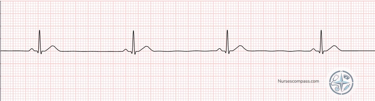 Sinus Bradycardia EKG Strip