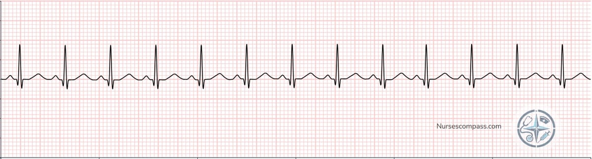 Sinus Tachycardia EKG Strip
