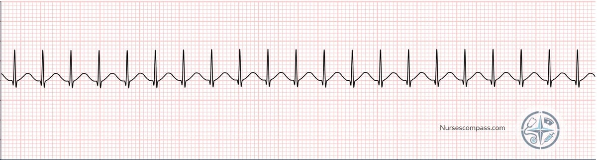 Supraventricular Tachycardia (SVT) EKG Strip