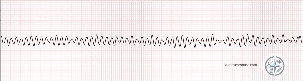 Ventricular Fibrillation (VF) EKG Strip