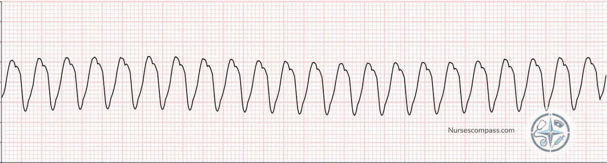 Ventricular Tachycardia (VT) EKG Strip