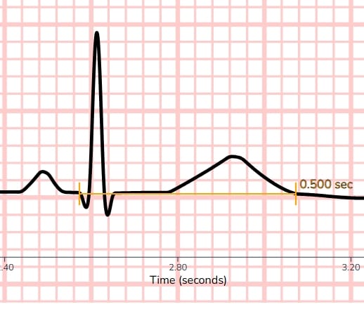 Prolonged QT Interval Example