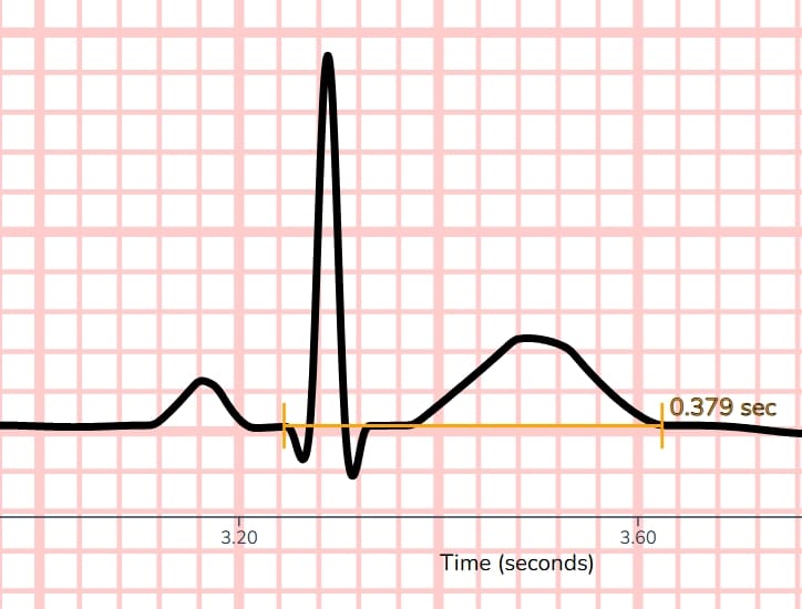 Normal QT Interval Example