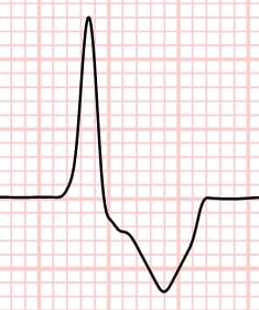 Premature ventricular complex with wide QRS - measure the width yourself