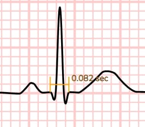 Normal narrow QRS complex measuring about 0.08 seconds