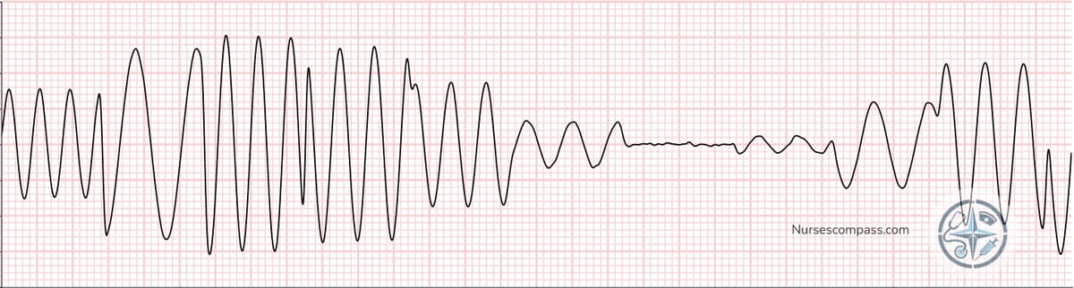 Torsades de Pointes twisting polymorphic VT prolonged repolarization pattern